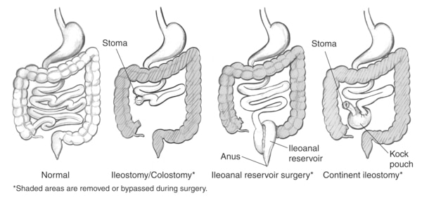 Drawings of a normal bowel and three types of bowel diversion surgeries, including ileostomy/colostomy, ileoanal reservoir, and continent ileostomy. The normal bowel drawing shows the stomach, small intestine, and large intestine. The ileostomy/colostomy drawing shows the stomach and a shortened small intestine that ends at a stoma. It also shows the large intestine, which is shaded to indicate it has been removed or bypassed during surgery. The stoma is labeled. The ileoanal reservoir surgery drawing shows the stomach and a shortened small intestine whose end has been turned into an ileoanal reservoir. It also shows the large intestine, which has been shaded to indicate it has been removed or bypassed during surgery. The anus and ileoanal reservoir are labeled. The continent ileostomy drawing shows the stomach and a shortened small intestine whose end has been turned into a Kock pouch. It also shows the large intestine, which is shaded to indicate it has been removed or bypassed during surgery. A short segment of bowel protrudes from the Kock pouch and ends at a stoma. The Kock pouch and stoma are labeled.