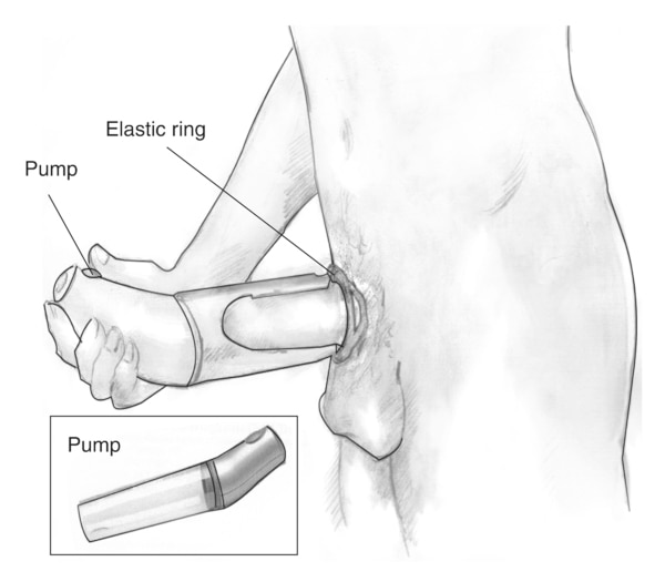 Drawing of a vacuum device placed around the penis to treat erectile dysfunction. Labels point to the pump, which draws air out of the cylinder, and an elastic ring, which, when fitted over the base of the penis, traps the blood and sustains the erection
