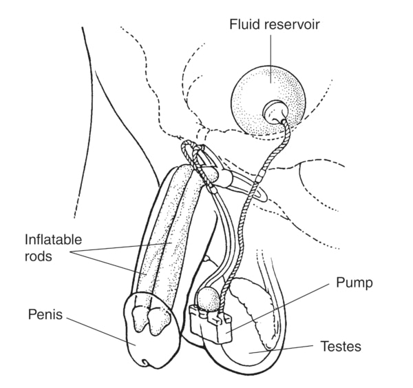 Drawing of an inflatable penile implant to treat erectile dysfunction. An erection is produced by squeezing a small pump implanted in the scrotum. The pump causes fluid to flow from a reservoir in the lower pelvis to two inflatable rods in the penis. The