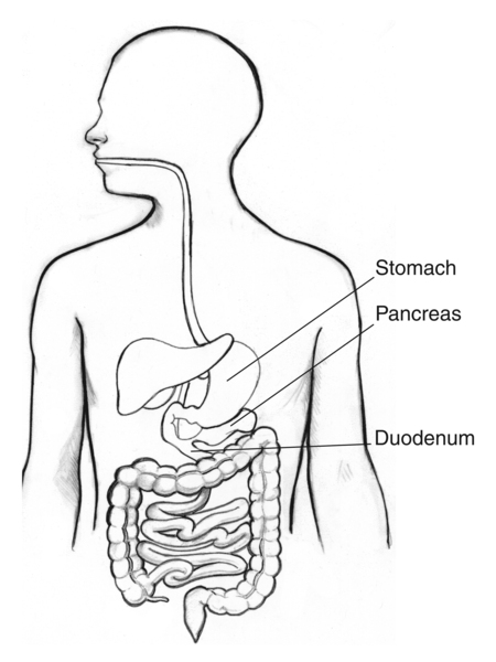 Drawing of the digestive tract with the stomach, pancreas, and duodenum labeled.