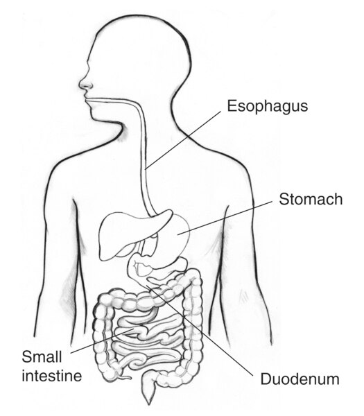 Drawing of the digestive tract with the esophagus, stomach, small intestine, and duodenum labeled.