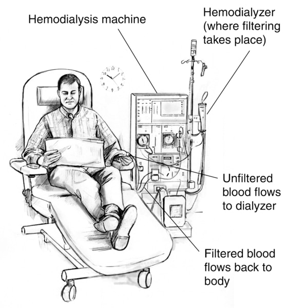 Drawing of a man receiving hemodialysis treatment. Labels point to the hemodialyzer, where filtering takes place; hemodialysis machine; a tube where unfiltered blood flows to the dialyzer; and a tube where filtered blood flows back to the patient's body.