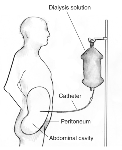 Diagram of a patient receiving continuous ambulatory peritoneal dialysis. Labels point to the dialysis solution, catheter, peritoneum, and abdominal cavity.