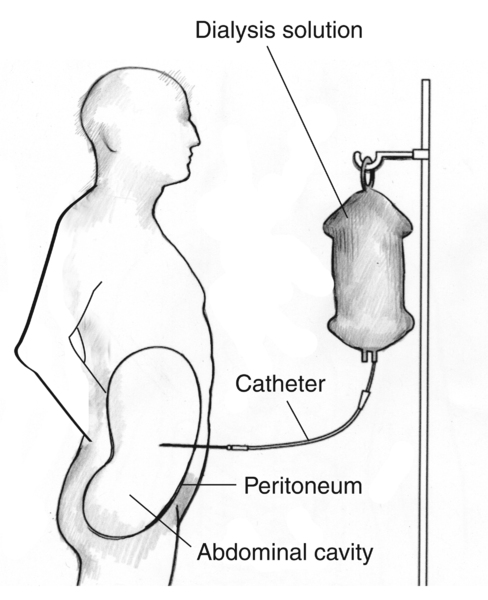 Diagram of a patient receiving continuous ambulatory peritoneal dialysis. Labels point to the dialysis solution, catheter, peritoneum, and abdominal cavity.