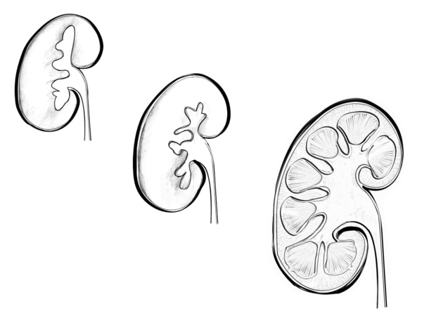 Drawing of three kidneys that represent different stages of development. At the upper left, the smallest kidney is connected to a ureter with only a couple of branches into the kidney. In the middle, a slightly larger kidney is connected to a ureter with
