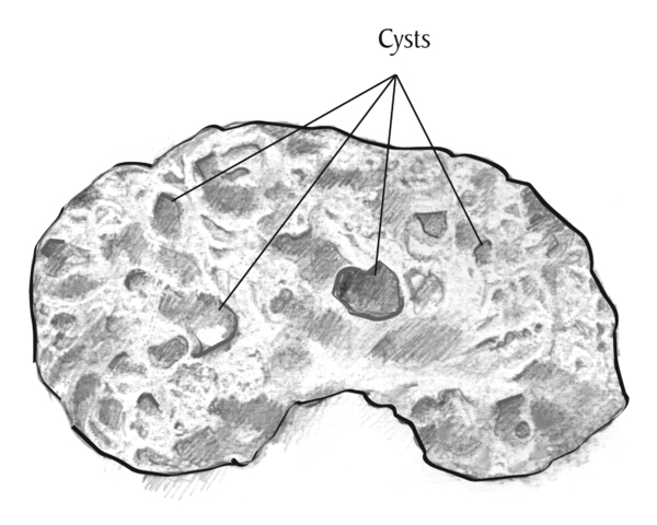 Drawing showing the cross section of a kidney with acquired cystic kidney disease. The label “cysts” appears above the kidney with lines pointing to sacs of fluid within the kidney.
