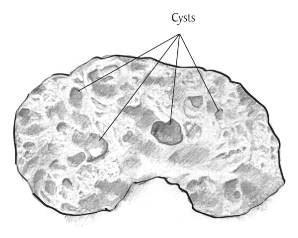 Drawing showing the cross section of a kidney with acquired cystic kidney disease. The label “cysts” appears above the kidney with lines pointing to sacs of fluid within the kidney.