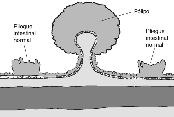 Ilustración de un pólipo en el colon con las etiquetas señalando un pólipo y dos pliegues normales de intestino.