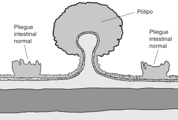 Ilustración de un pólipo en el colon con las etiquetas señalando un pólipo y dos pliegues normales de intestino.