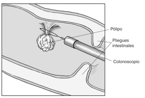Ilustración de un pólipo en el colon que se está extirpando con un colonoscopio con etiquetas que señalan hacia el pólipo, el colonoscopio y dos pliegues intestinales. El bucle del alambre al final del colonoscopio se encuentra alrededor de la base del pólipo.