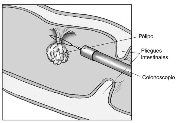 Ilustración de un pólipo en el colon que se está extirpando con un colonoscopio con etiquetas que señalan hacia el pólipo, el colonoscopio y dos pliegues intestinales. El bucle del alambre al final del colonoscopio se encuentra alrededor de la base del pólipo.