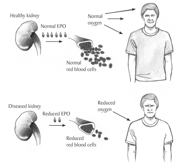 Diagram showing the process of red blood cell production in the body with healthy and diseased kidneys. On the top half of the diagram, on the left side, a kidney labeled “Healthy kidney” starts the process by producing EPO. Six drops represent “Normal EP