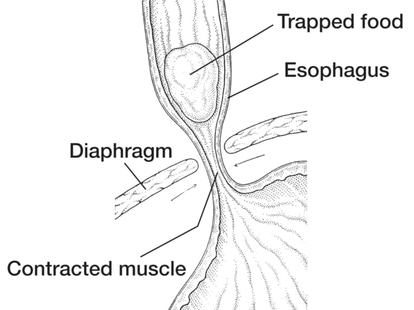 Drawing of the esophagus showing achalasia with the esophagus, diaphragm, contracted muscle, and trapped food labeled.