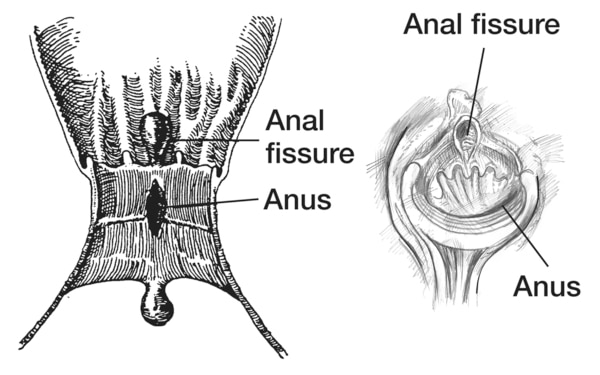 Left: drawing of a cross section of the anus with a fissure. Right: drawing of a direct view of the anus with a fissure.