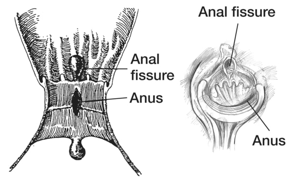 Cross Section And A Direct View Of The Anus With A Fissure Media 