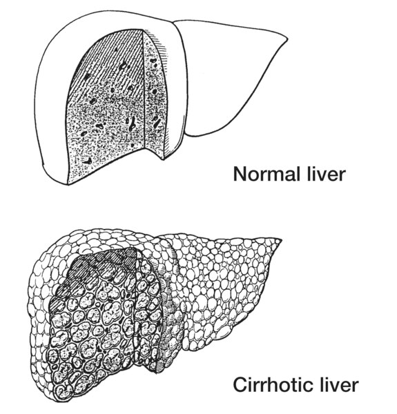 Top: drawing of a portion of normal liver tissue. Bottom: drawing of a portion of cirrhotic liver tissue
