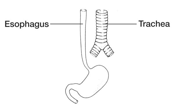 Drawing of a normally developed esophagus with labels pointing to the esophagus and trachea.