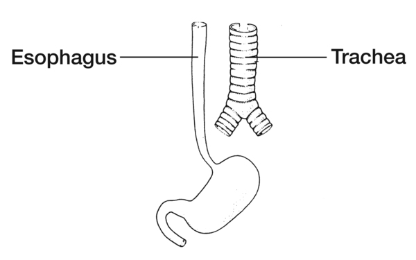 Drawing of a normally developed esophagus with labels pointing to the esophagus and trachea.