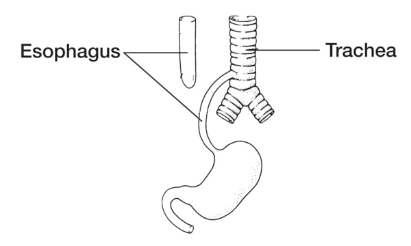 Drawing of one form of esophageal atresia with labels pointing to the esophagus and trachea.