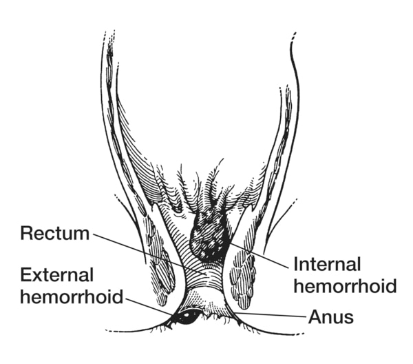 Drawing of the rectum and anus with an internal hemorrhoid and an external hemorrhoid labeled.