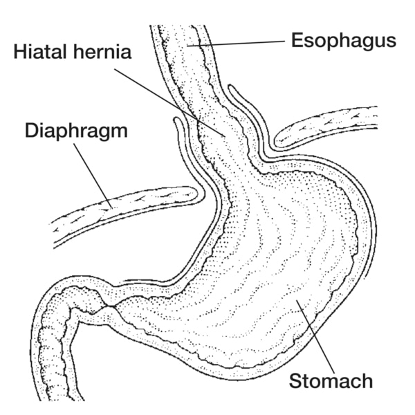 Drawing of a hiatal hernia with the esophagus, diaphragm, stomach, and hiatal hernia labeled.
