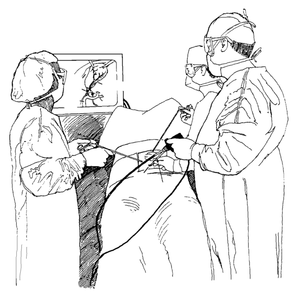 Drawing of laparoscopic cholecystectomy to remove the gallbladder. A surgeon and assistants are shown holding the laparoscope and viewing the procedure on a monitor.