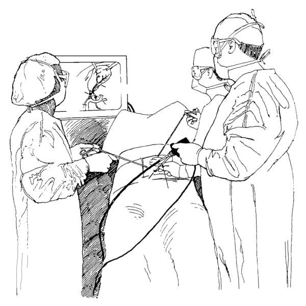 Drawing of laparoscopic cholecystectomy to remove the gallbladder. A surgeon and assistants are shown holding the laparoscope and viewing the procedure on a monitor.