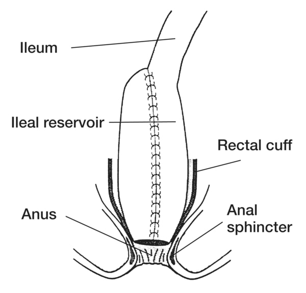 Drawing of an ileoanal pouch anastomosis with the ileum, ileal reservoir, rectal cuff, anus, and anal sphincter labeled.