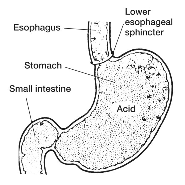 Drawing of the lower esophageal sphincter with the esophagus, lower esophageal sphincter, stomach with acid, and small intestine labeled.