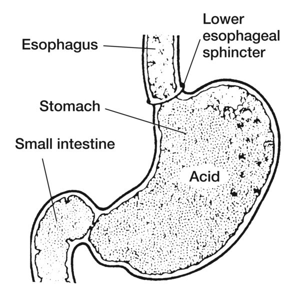 Drawing of the lower esophageal sphincter with the esophagus, lower esophageal sphincter, stomach with acid, and small intestine labeled.