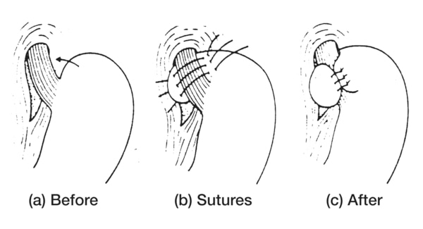 Drawings of the stomach and esophagus: before the Nissen fundoplication operation, with stiches,, and after the Nissen fundoplication operation.