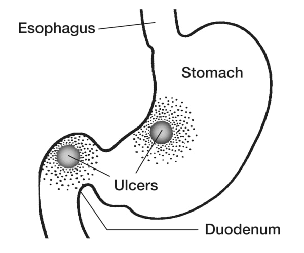 Drawing of the stomach and duodenum with the stomach, duodenum, esophagus, and ulcers labeled.