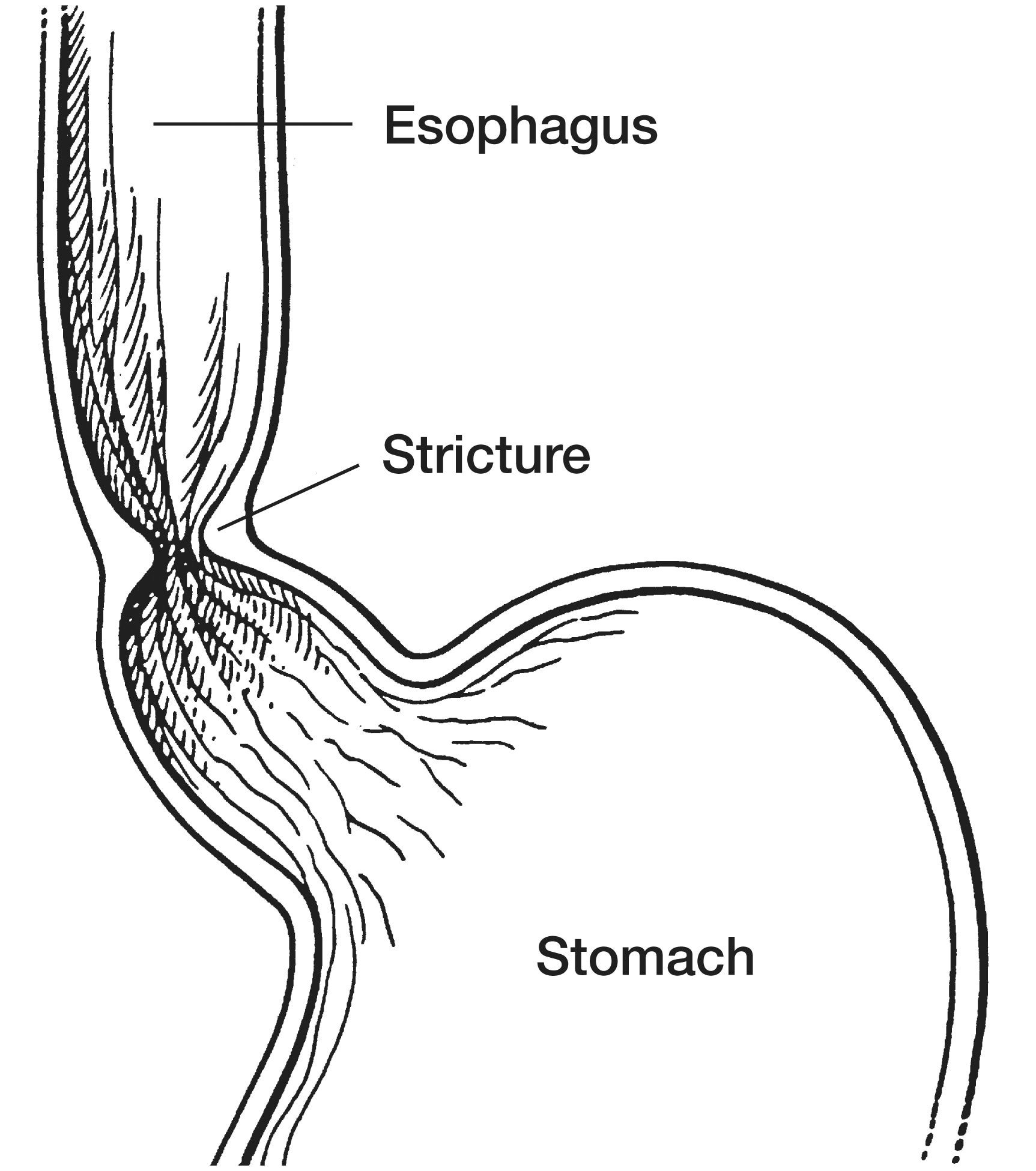 Stricture, or narrowing, of the esophagus Media Asset NIDDK