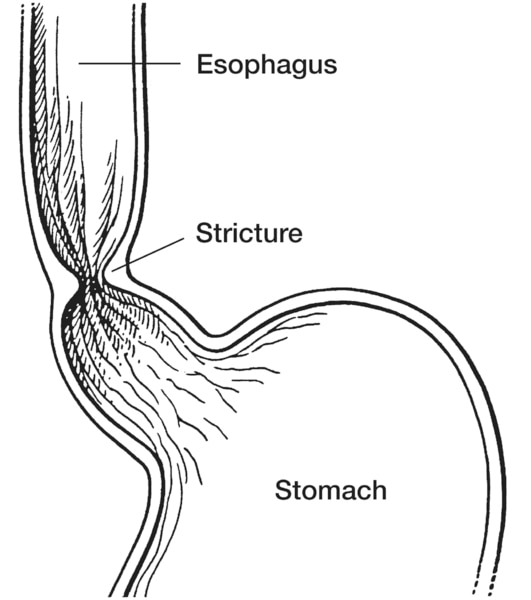 Drawing of a stricture, or narrowing, of the esophagus with the esophagus, stricture, and stomach labeled.