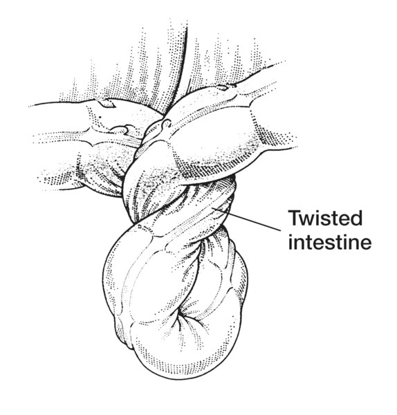 Drawing of the intestine showing volvulus, or twisted intestine. A label points to the twisted intestine.