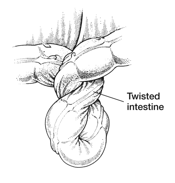 Drawing of the intestine showing volvulus, or twisted intestine. A label points to the twisted intestine.
