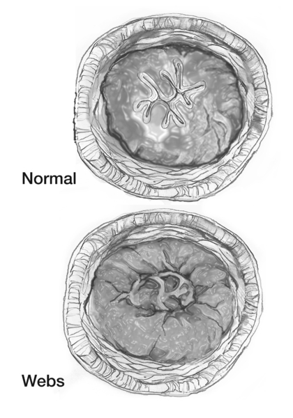 Top: drawing of a cross section of a normal esophagus. Bottom: drawing of a cross section of an esophagus with webs.