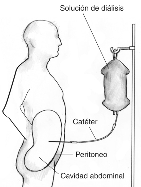 Diagrama de un paciente que está recibiendo diálisis peritoneal ambulatoria continua. Las etiquetas señalan la solución de diálisis, el catéter, el peritoneo y la cavidad abdominal.