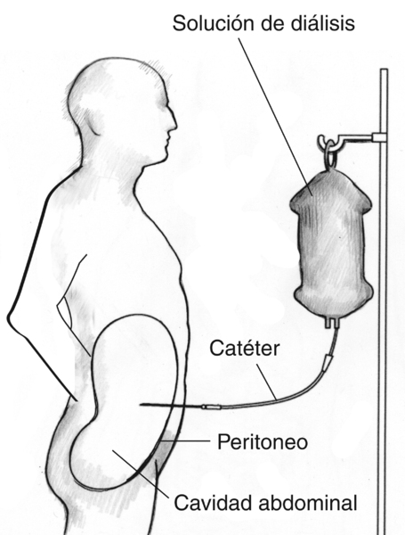 Diagrama de un paciente que está recibiendo diálisis peritoneal ambulatoria continua. Las etiquetas señalan la solución de diálisis, el catéter, el peritoneo y la cavidad abdominal.