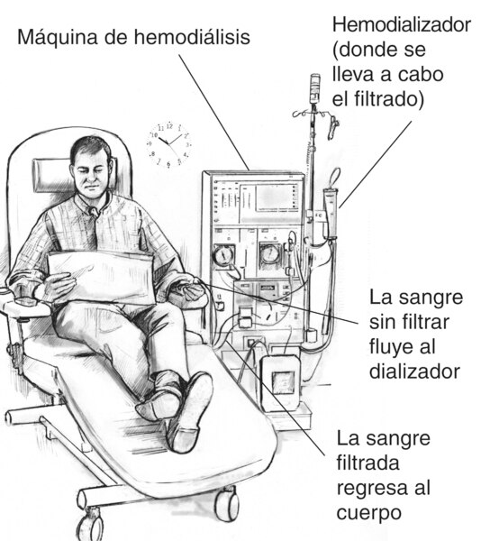 Ilustración de un hombre que está recibiendo tratamiento de hemodiálisis. Las etiquetas señalan el hemodializador, donde se lleva a cabo el filtrado; la máquina de hemodiálisis; un tubo por donde la sangre sin filtrar fluye hacia el dializador y un tubo p