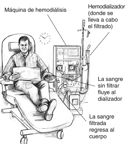 Ilustración de un hombre que está recibiendo tratamiento de hemodiálisis. Las etiquetas señalan el hemodializador, donde se lleva a cabo el filtrado; la máquina de hemodiálisis; un tubo por donde la sangre sin filtrar fluye hacia el dializador y un tubo p