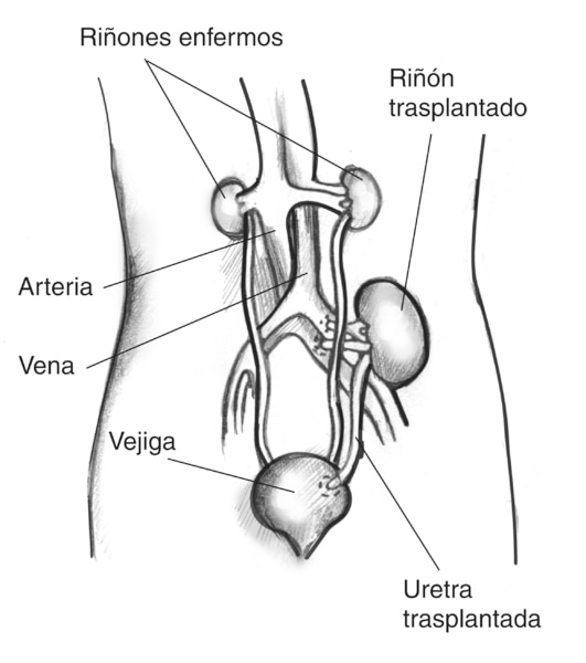 Diagrama anatómico de una silueta femenina con un riñón trasplantado. Los dos riñones enfermos se encuentran todavía en su lugar a cada lado de la columna, debajo de las costillas. El riñón trasplantado se encuentra del lado izquierdo, justo encima de la