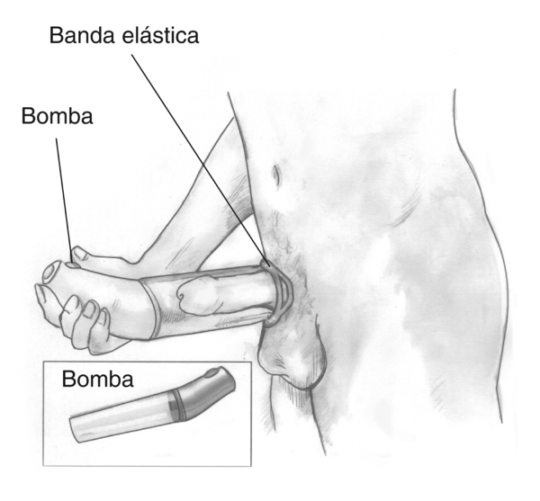 Ilustración de un dispositivo de vacío colocado alrededor del pene para tratar la disfunción eréctil. Las etiquetas señalan hacia la bomba, que extrae aire fuera del cilindro, y a una banda elástica, la cual puesta sobre la base del pene sostiene a la ere