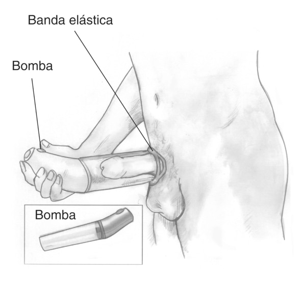 Ilustración de un dispositivo de vacío colocado alrededor del pene para tratar la disfunción eréctil. Las etiquetas señalan hacia la bomba, que extrae aire fuera del cilindro, y a una banda elástica, la cual puesta sobre la base del pene sostiene a la ere