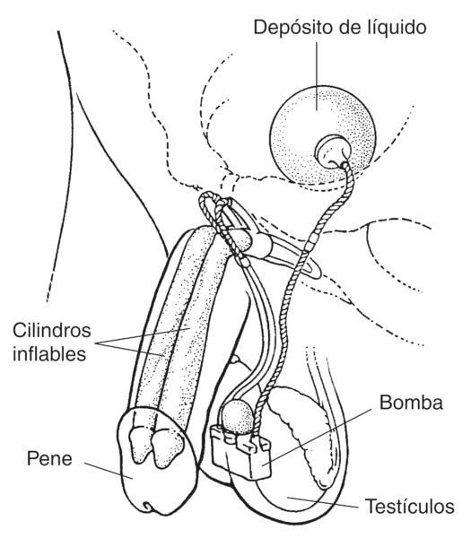 Ilustración de un implante inflable para tratar la disfunción eréctil. Una erección se produce apretando una pequeña bomba implantada en el escroto. La bomba causa que el fluido que se encuentra en un depósito de la pelvis inferior fluya hacia dos cilindr