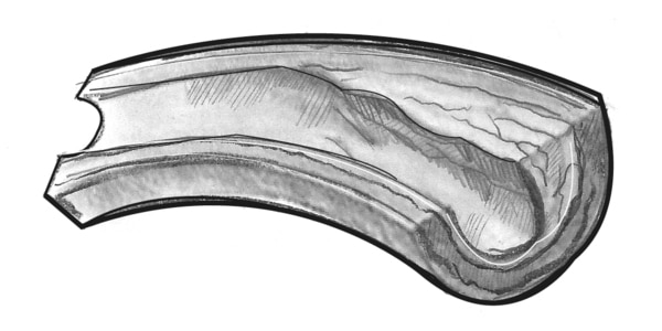 Drawing of a narrowed blood vessel.