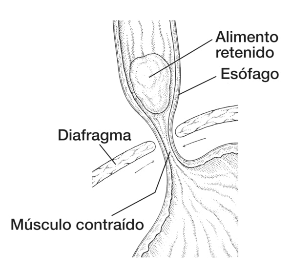 Dibujo del esófago que muestra acalasia en el esófago; se señala el esófago, diafragma, músculo contraído y alimento retenido.