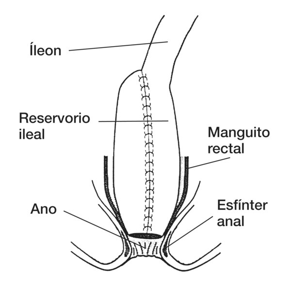 Dibujo de anastosmosis con bolsa ileoanal en la que se señala el íleon, reservorio ileal, manguito rectal, ano y esfínter anal.