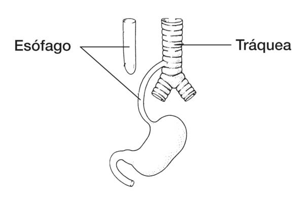 Dibujo de un tipo de atresia esofágica, se señalan el esófago y la tráquea.