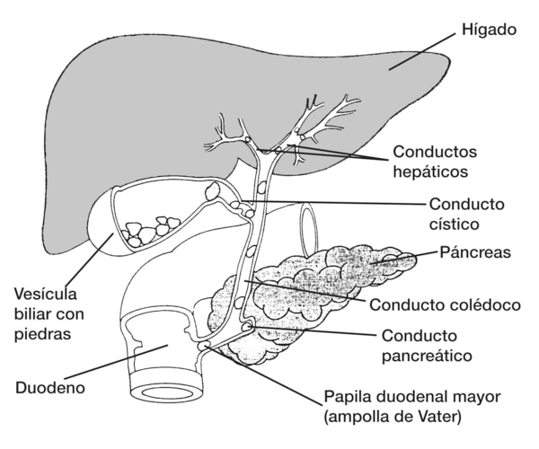 Dibujo del sistema biliar incluyendo la vesícula con cálculos biliares. Se señala el hígado, conductos hepáticos, vesícula biliar con piedras, conducto cístico, páncreas y duodeno. Se muestran cálculos biliares pasando por el conducto hepático, conducto c